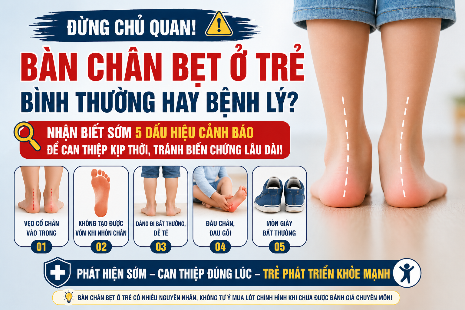 DẤU HIỆU NHẬN BIẾT BÀN CHÂN BẸT TRẺ EM